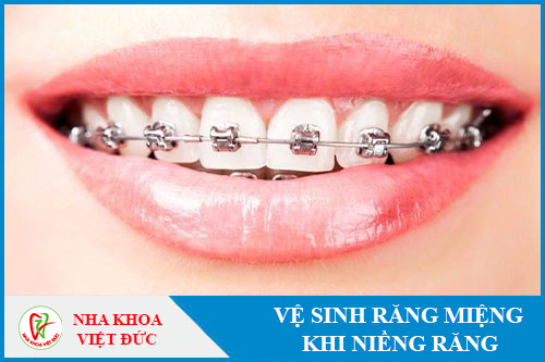 Vệ sinh răng miệng đúng cách trong quá trình niềng răng