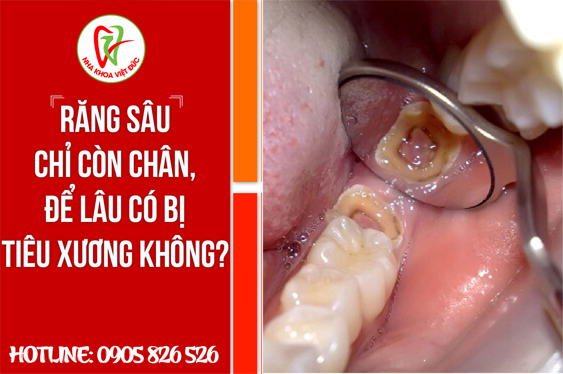 RĂNG SÂU CHỈ CÒN CHÂN, ĐỂ LÂU CÓ BỊ TIÊU XƯƠNG Ổ RĂNG KHÔNG?