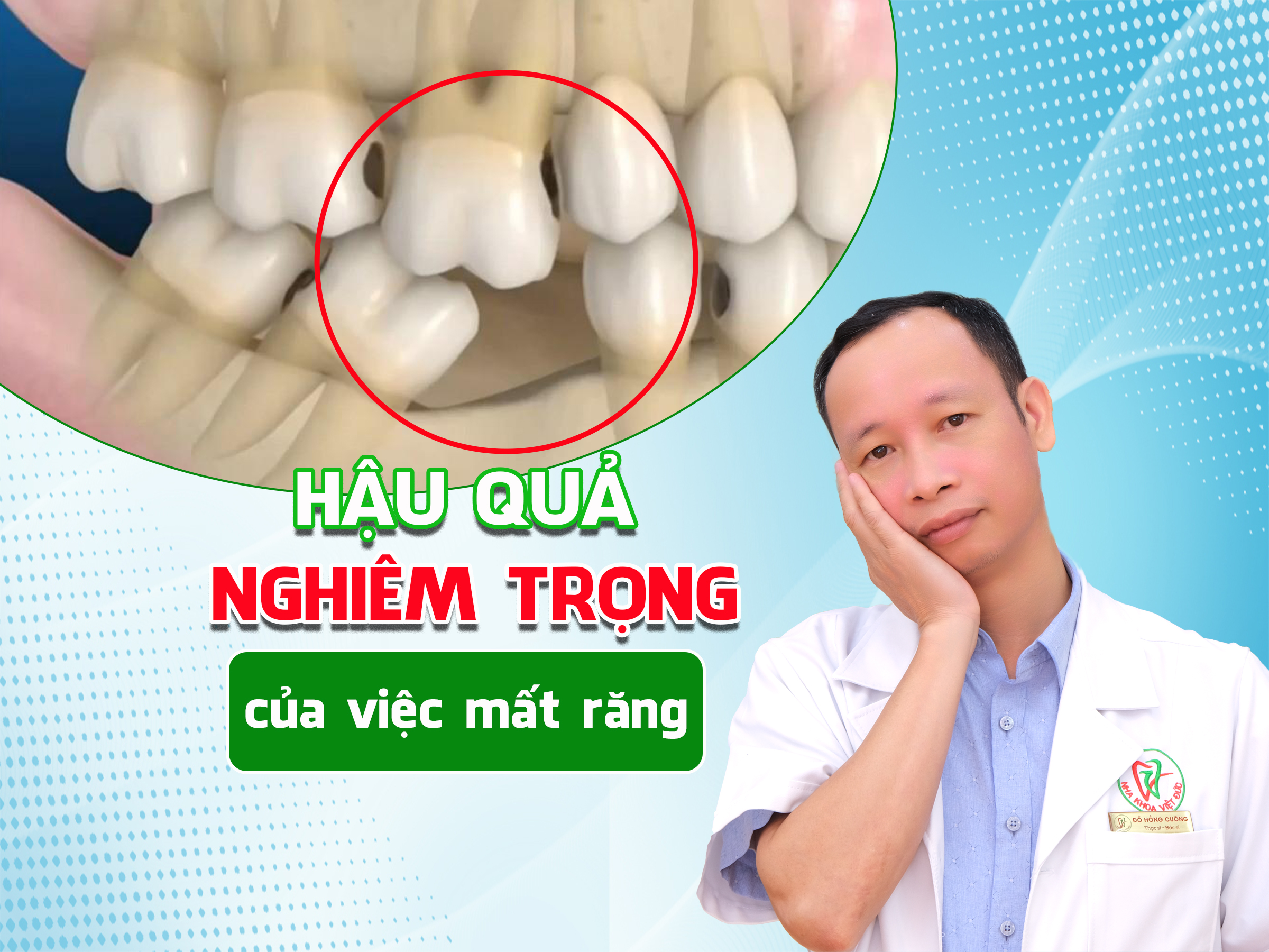 HẬU QUẢ NGHIÊM TRỌNG CỦA VIỆC MẤT RĂNG