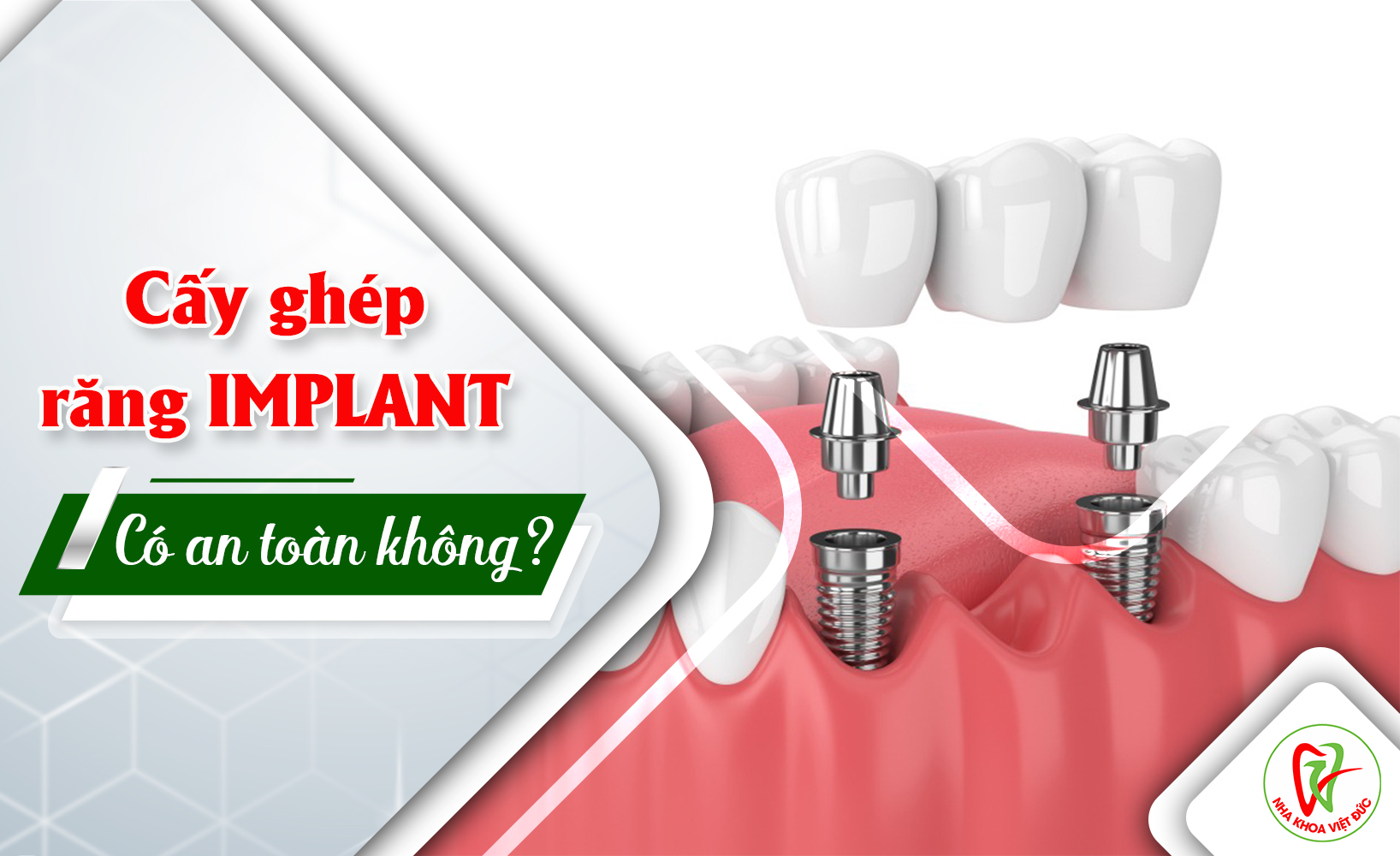 CẤY GHÉP RĂNG IMPLANT CÓ AN TOÀN KHÔNG?