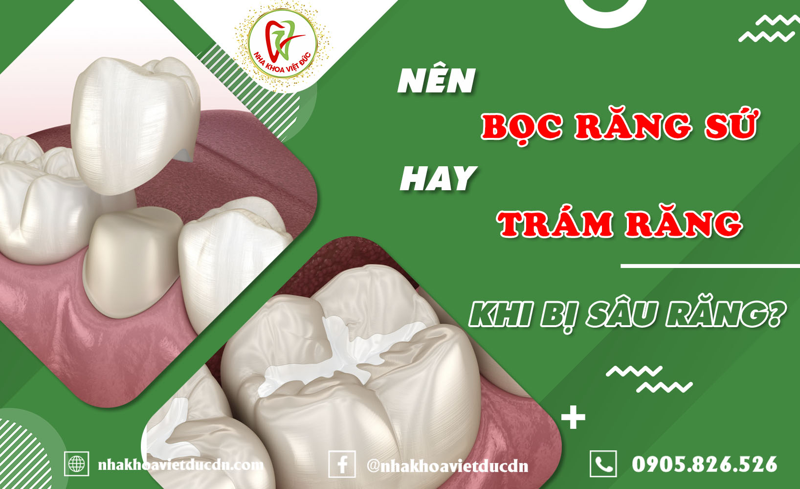 NÊN BỌC RĂNG SỨ HAY TRÁM RĂNG KHI BỊ SÂU RĂNG?