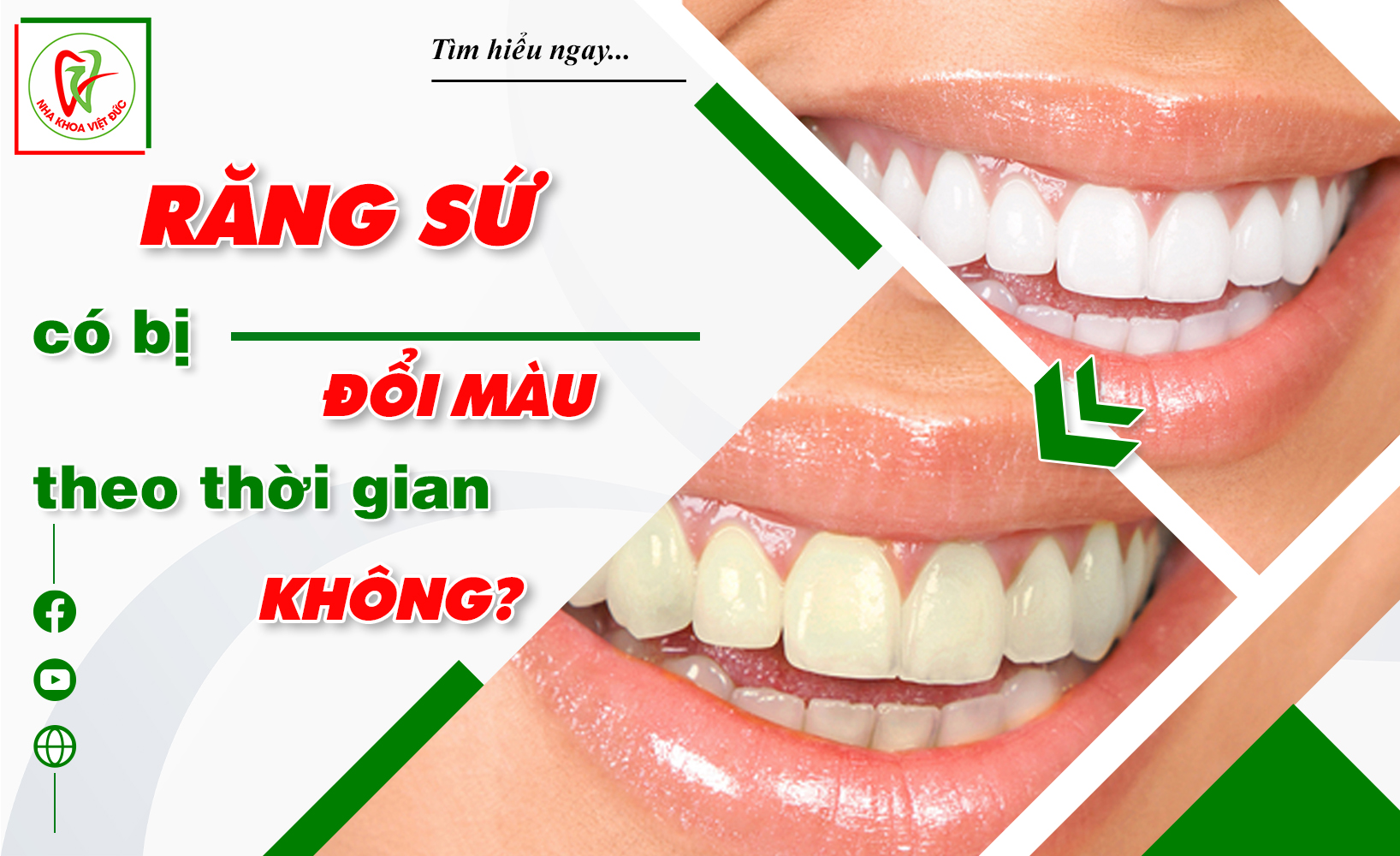 RĂNG SỨ CÓ BỊ ĐỔI MÀU THEO THỜI GIAN KHÔNG?