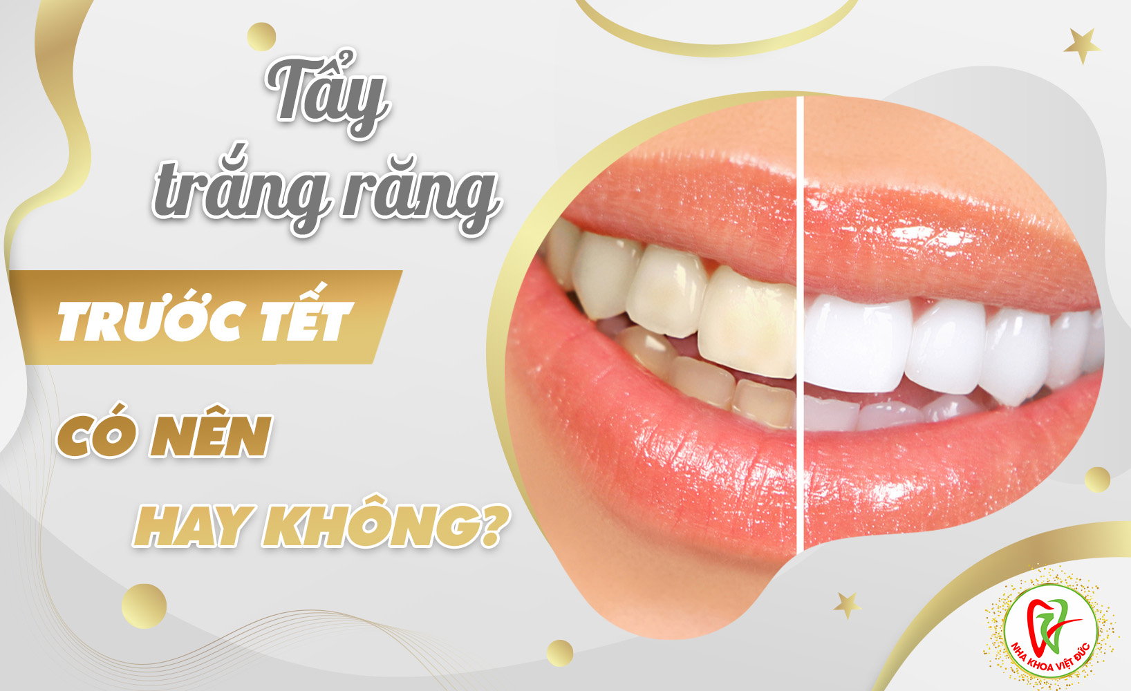 TẨY TRẮNG RĂNG TRƯỚC TẾT – CÓ NÊN HAY KHÔNG?