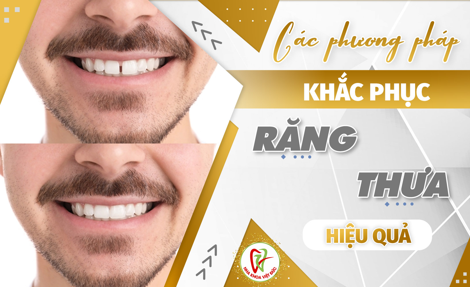 CÁC PHƯƠNG PHÁP KHẮC PHỤC RĂNG THƯA HIỆU QUẢ