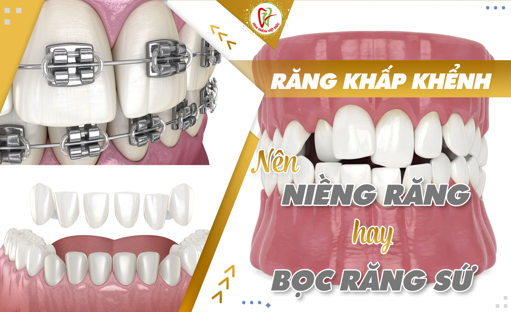 NÊN NIỀNG RĂNG HAY BỌC RĂNG SỨ KHI RĂNG BỊ KHẤP KHỂNH 