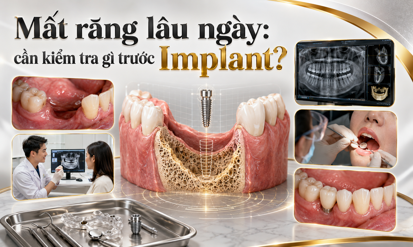 Mất răng lâu ngày: cần kiểm tra gì trước khi trồng Implant?